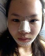 达拉斯隆鼻+自体脂肪丰下巴案例