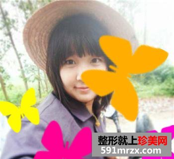 三点式双眼皮