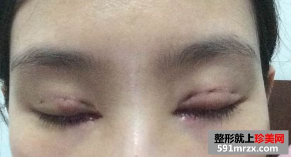 北京生物焊接双眼皮