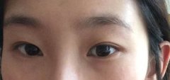 在北京做的生物焊接双眼皮期待效果哟