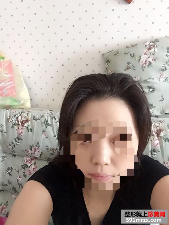 假体隆鼻恢复时间