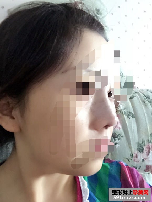 假体隆鼻恢复时间