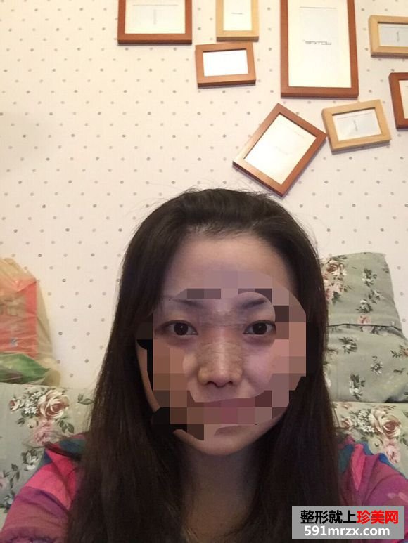 假体隆鼻恢复时间