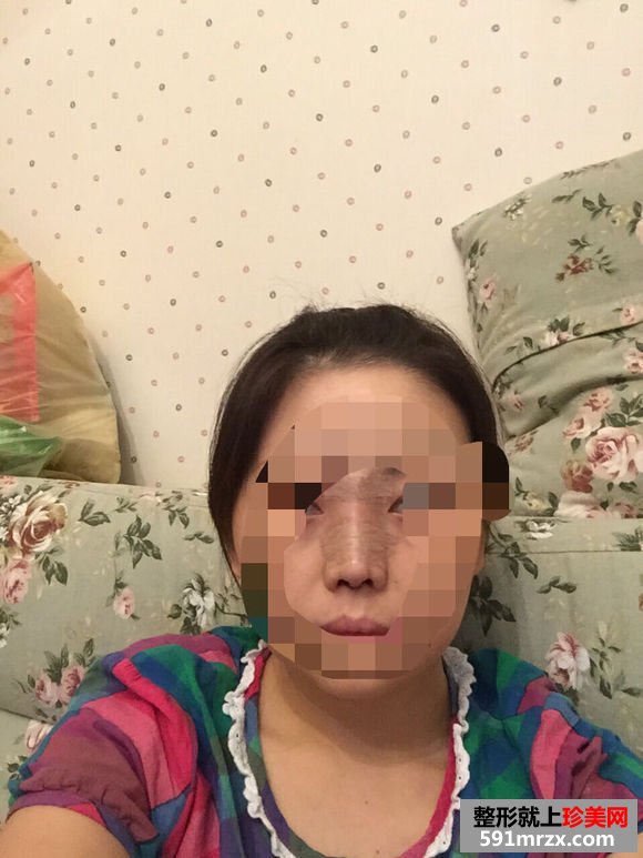 假体隆鼻恢复时间
