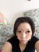 我想知道假体隆鼻的恢复时间是多久啊
