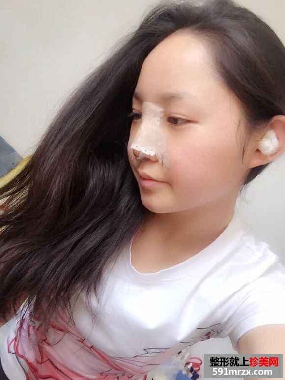 注射隆鼻取出,自体耳软骨隆鼻