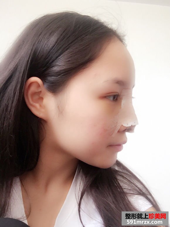 注射隆鼻取出,自体耳软骨隆鼻
