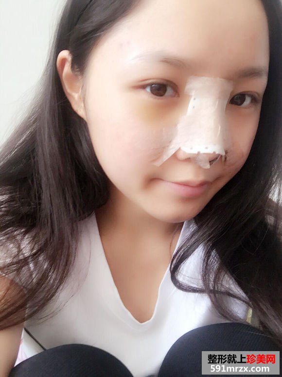注射隆鼻取出,自体耳软骨隆鼻