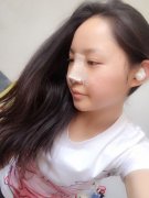 注射隆鼻取出+自体耳软骨隆鼻四天了感觉很好呢