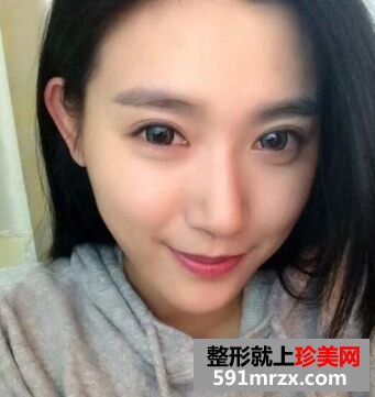 做了韩式三点双眼皮和隆鼻恢复后晒图