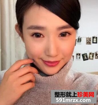 做了韩式三点双眼皮和隆鼻恢复后晒图
