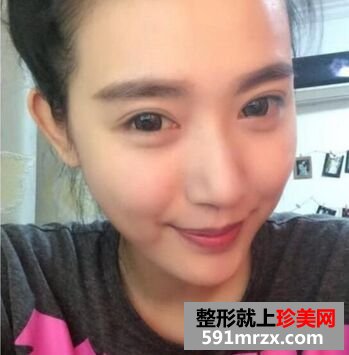 做了韩式三点双眼皮和隆鼻恢复后晒图