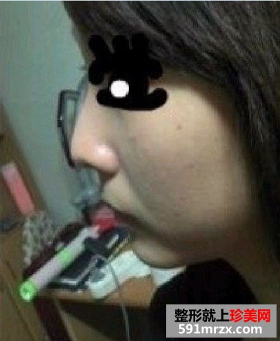 北京硅胶隆鼻效果好吗