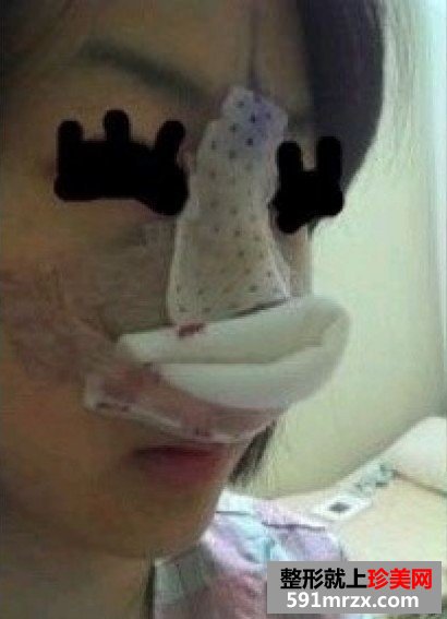 北京硅胶隆鼻效果好吗