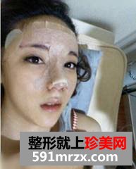 假体隆鼻后效果自然吗