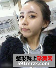 假体隆鼻后效果自然吗