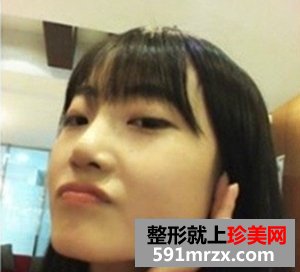 下颌角整形