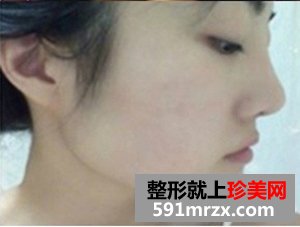 下颌角整形