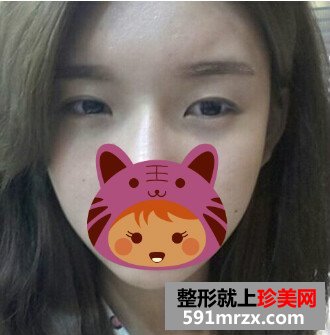 北京开外眼角,高分子埋线双眼皮