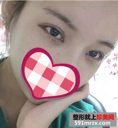 北京开外眼角,高分子埋线双眼皮