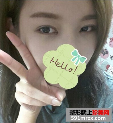 北京开外眼角,高分子埋线双眼皮