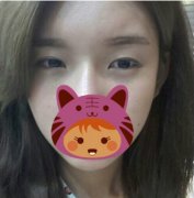在北京做的开外眼角+高分子埋线双眼皮多了几分自信