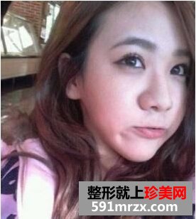 鼻尖肥大整形+鼻翼缩小前后对比 不再是“猪鼻子”