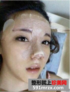鼻尖肥大整形+鼻翼缩小前后对比 不再是“猪鼻子”