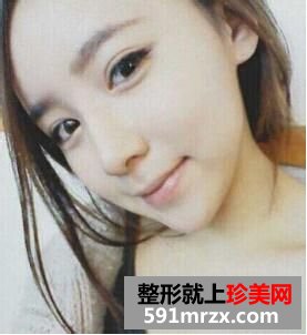 鼻尖肥大整形+鼻翼缩小前后对比 不再是“猪鼻子”