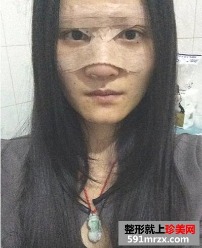 耳软骨隆鼻有后遗症吗