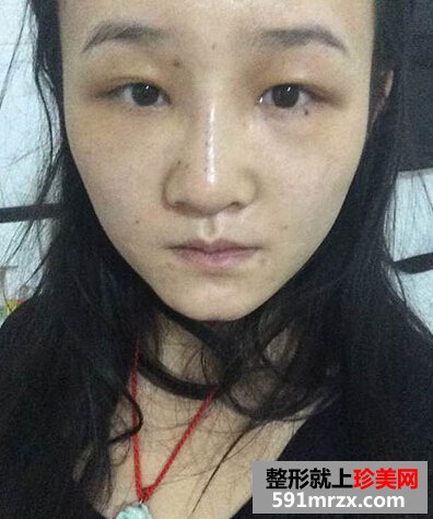 耳软骨隆鼻有后遗症吗