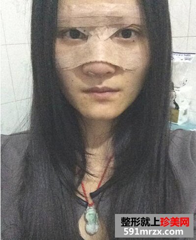 耳软骨隆鼻有后遗症吗