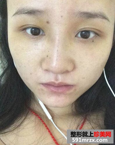 耳软骨隆鼻有后遗症吗