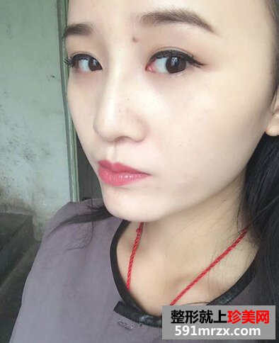 耳软骨隆鼻有后遗症吗