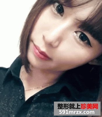 磨骨瘦脸,垫下巴前后对比图