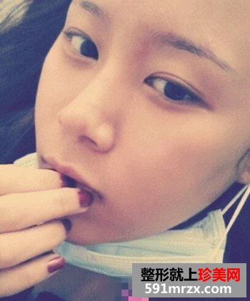 磨骨瘦脸,垫下巴前后对比图