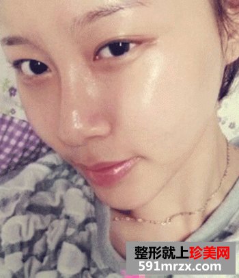 磨骨瘦脸,垫下巴前后对比图