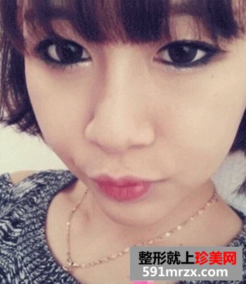 磨骨瘦脸,垫下巴前后对比图