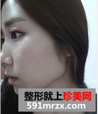 颧骨整形手术
