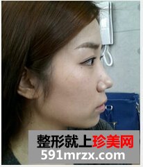 颧骨整形手术