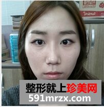 颧骨整形手术