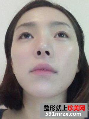 玻尿酸丰额头,隆下巴过程