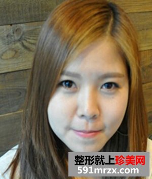 法令纹深怎么办,玻尿酸祛法令纹