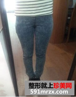 臀部吸脂手术,超级无敌变身美