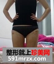 臀部吸脂手术,超级无敌变身美