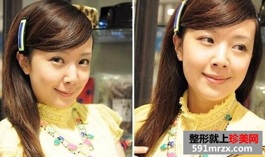 打瘦脸针前后效果图