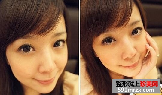 打瘦脸针前后效果图