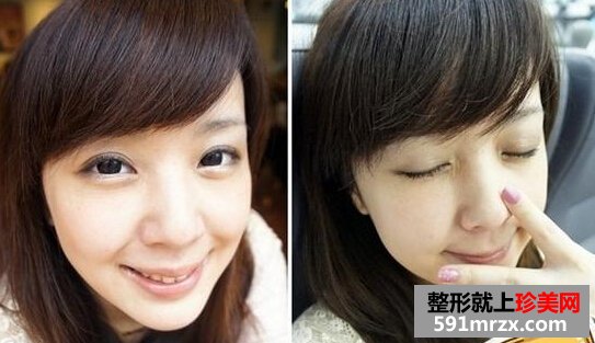 打瘦脸针前后效果图