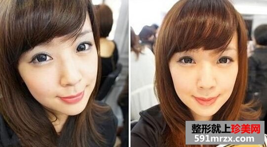 打瘦脸针前后效果图