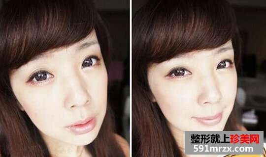 瘦脸针效果怎样